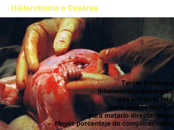  • Histerotomía o Cesárea - Tercer trimestre - Intervención quirúrgica que extrae el