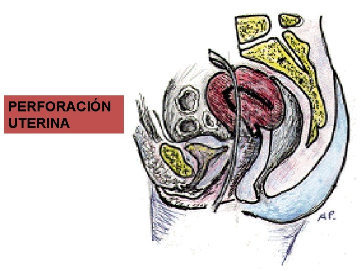 PERFORACIÓN UTERINA 