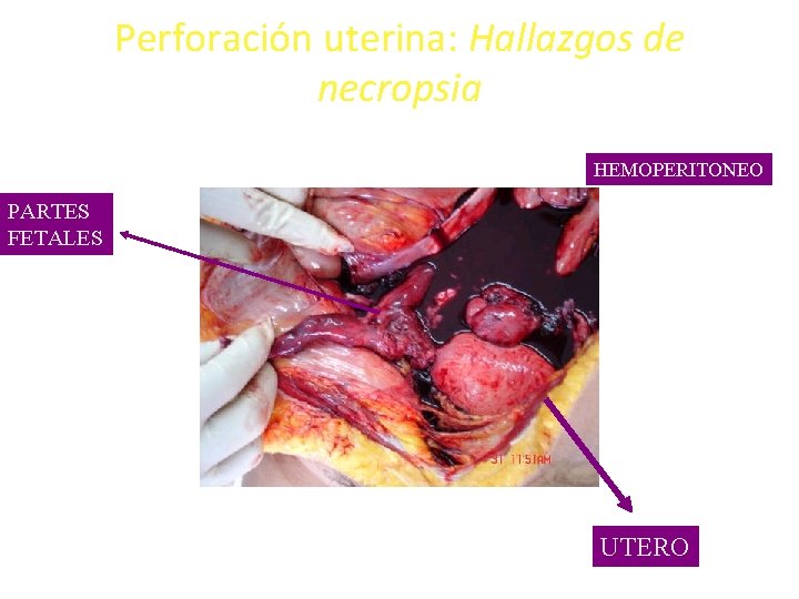 Perforación uterina: Hallazgos de necropsia HEMOPERITONEO PARTES FETALES UTERO 