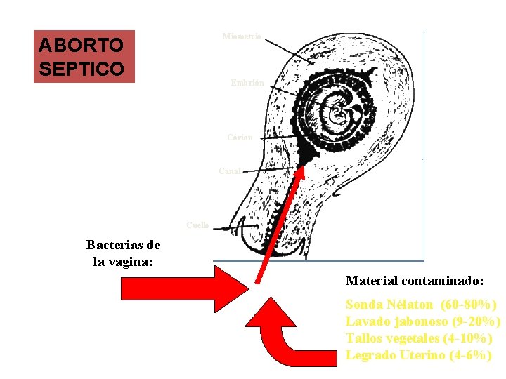 Miometrio ABORTO SEPTICO Embrión Córion Canal Cuello Bacterias de la vagina: Material contaminado: Sonda