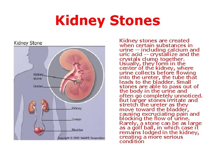 Kidney Stones Kidney stones are created when certain substances in urine -- including calcium