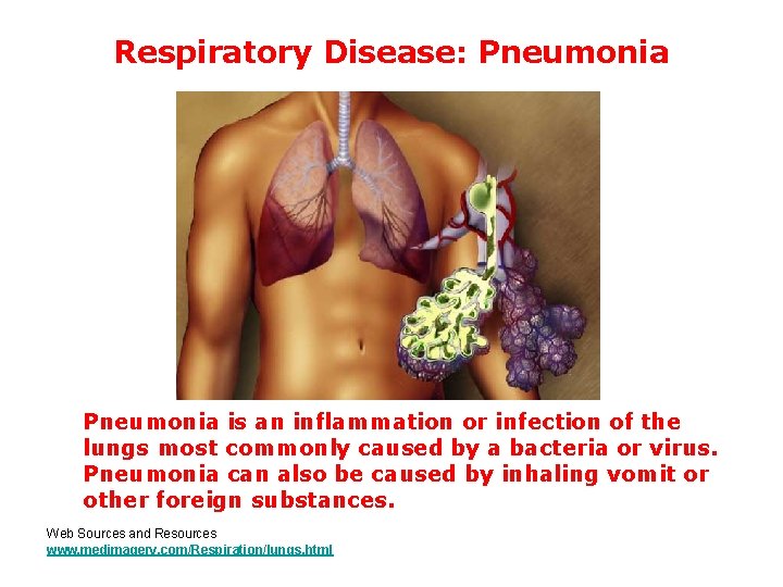 Respiratory Disease: Pneumonia is an inflammation or infection of the lungs most commonly caused