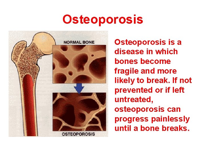 Osteoporosis is a disease in which bones become fragile and more likely to break.