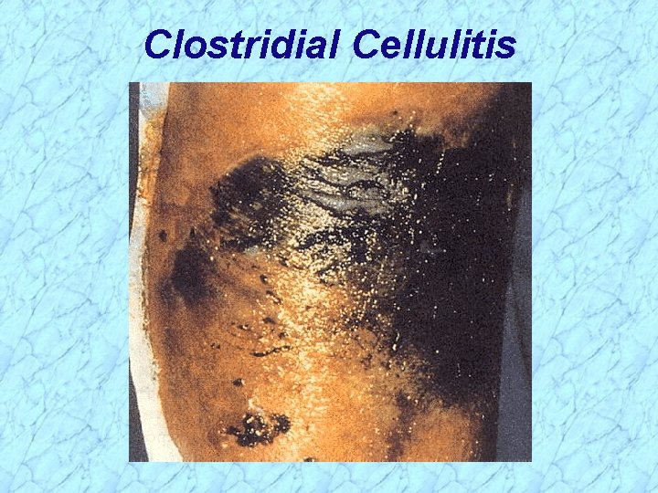 Clostridial Cellulitis 