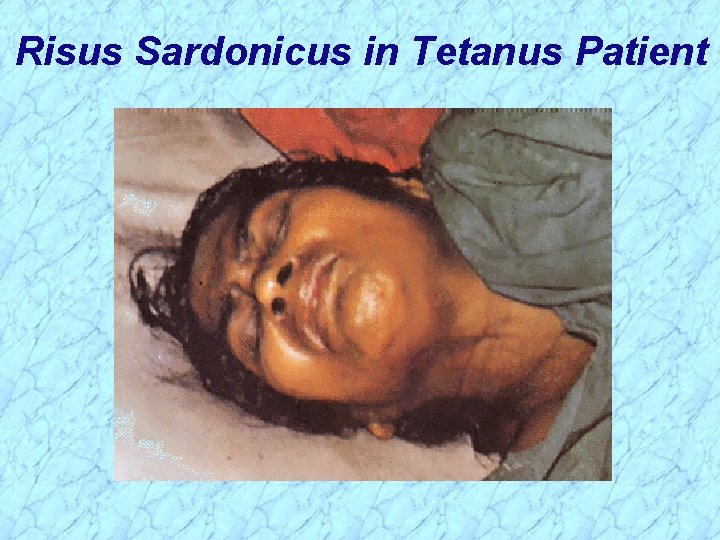 Risus Sardonicus in Tetanus Patient 