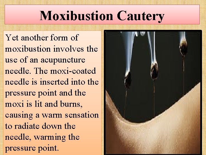 Moxibustion Cautery Yet another form of moxibustion involves the use of an acupuncture needle.