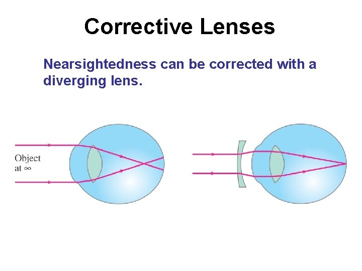 Corrective Lenses Nearsightedness can be corrected with a diverging lens. 