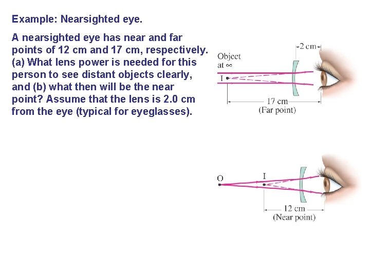 Example: Nearsighted eye. A nearsighted eye has near and far points of 12 cm