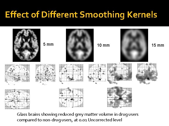 Effect of Different Smoothing Kernels 5 mm 10 mm Glass brains showing reduced grey