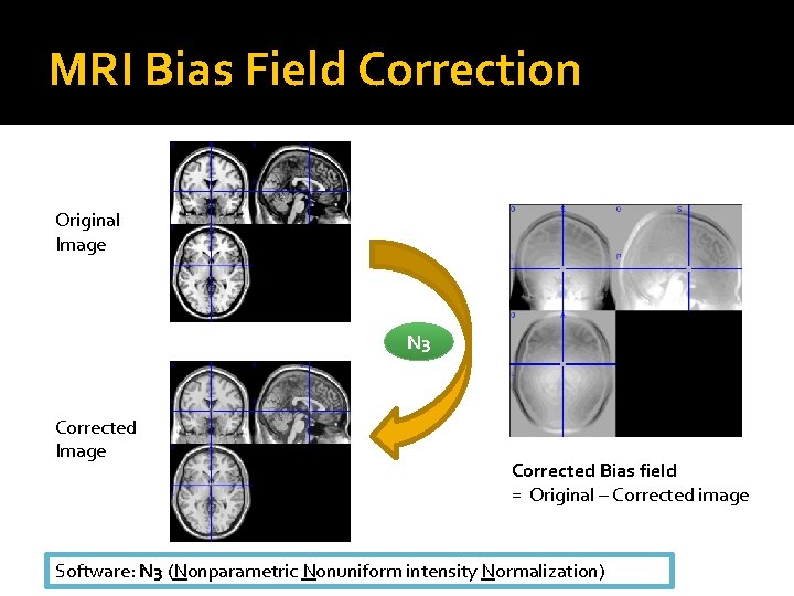 MRI Bias Field Correction Original Image N 3 Corrected Image Corrected Bias field =