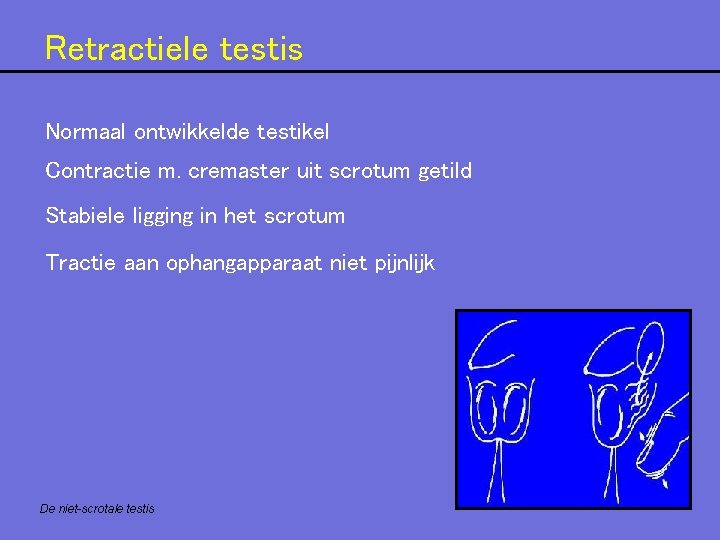 Retractiele testis Normaal ontwikkelde testikel Contractie m. cremaster uit scrotum getild Stabiele ligging in Retractiele testis Normaal ontwikkelde testikel Contractie m. cremaster uit scrotum getild Stabiele ligging in