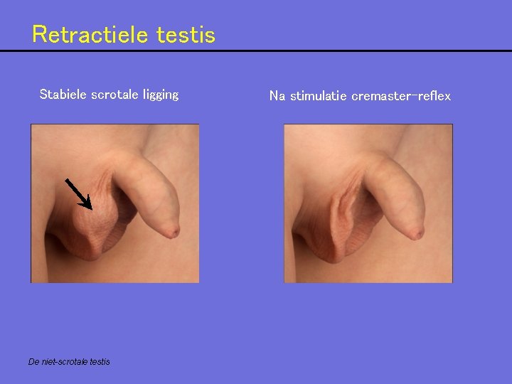 Retractiele testis Stabiele scrotale ligging De niet-scrotale testis Na stimulatie cremaster-reflex 