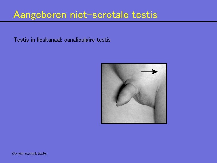Aangeboren niet-scrotale testis Testis in lieskanaal: canaliculaire testis De niet-scrotale testis Aangeboren niet-scrotale testis Testis in lieskanaal: canaliculaire testis De niet-scrotale testis