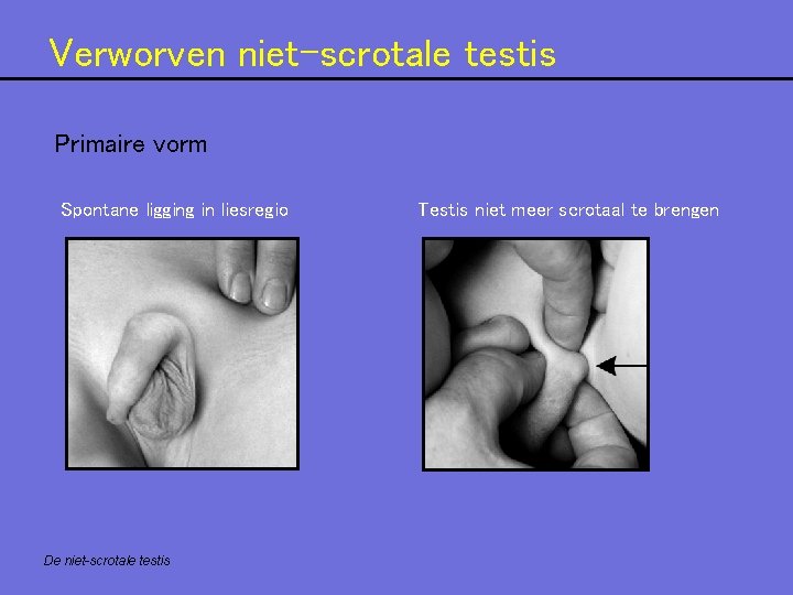 Verworven niet-scrotale testis Primaire vorm Spontane ligging in liesregio De niet-scrotale testis Testis niet Verworven niet-scrotale testis Primaire vorm Spontane ligging in liesregio De niet-scrotale testis Testis niet