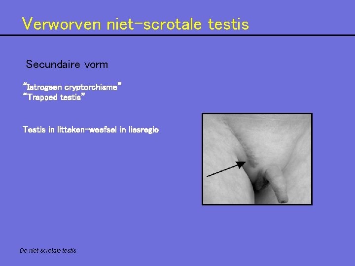 Verworven niet-scrotale testis Secundaire vorm “Iatrogeen cryptorchisme” “Trapped testis” Testis in litteken-weefsel in liesregio Verworven niet-scrotale testis Secundaire vorm “Iatrogeen cryptorchisme” “Trapped testis” Testis in litteken-weefsel in liesregio