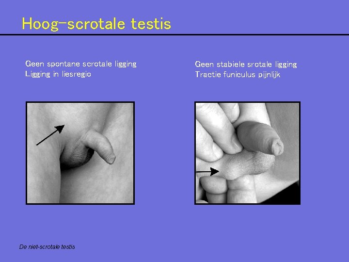 Hoog-scrotale testis Geen spontane scrotale ligging Ligging in liesregio De niet-scrotale testis Geen stabiele