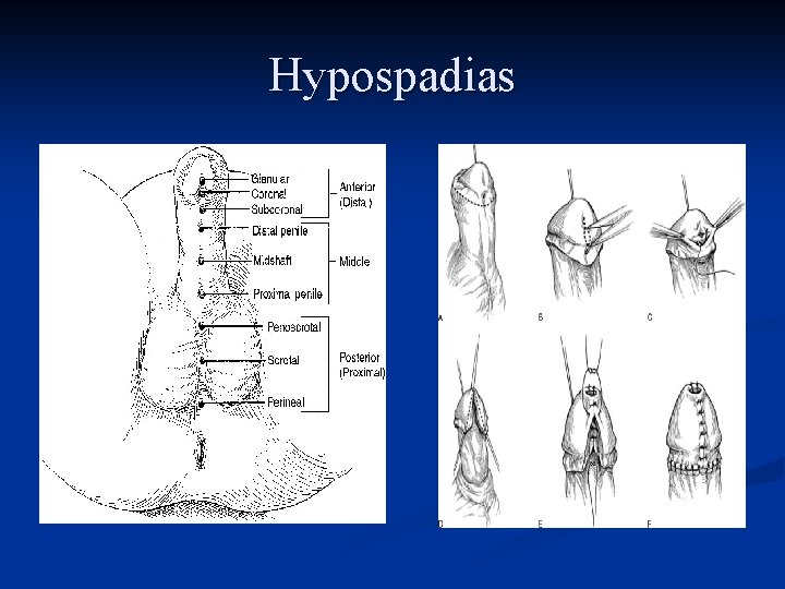 Hypospadias 