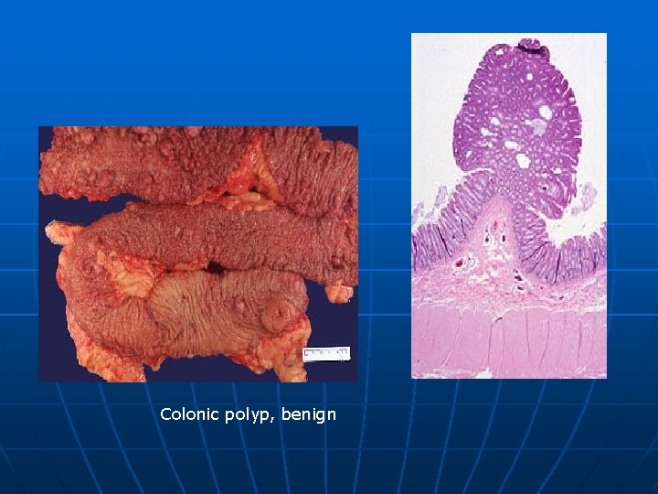 Colonic polyp, benign 