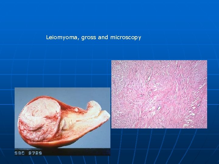 Leiomyoma, gross and microscopy 