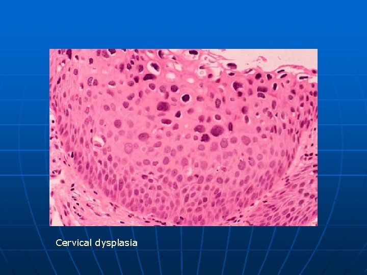 Cervical dysplasia 