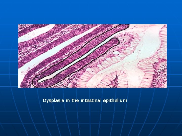 Dysplasia in the intestinal epithelium 