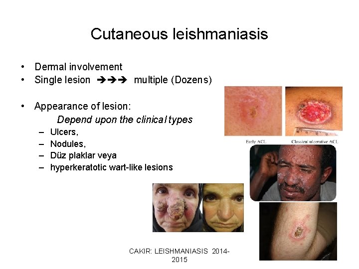 Cutaneous leishmaniasis • Dermal involvement • Single lesion multiple (Dozens) • Appearance of lesion: