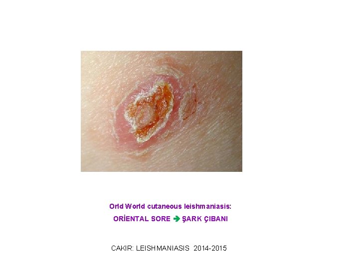 Orld World cutaneous leishmaniasis: ORİENTAL SORE ŞARK ÇIBANI CAKIR: LEISHMANIASIS 2014 -2015 
