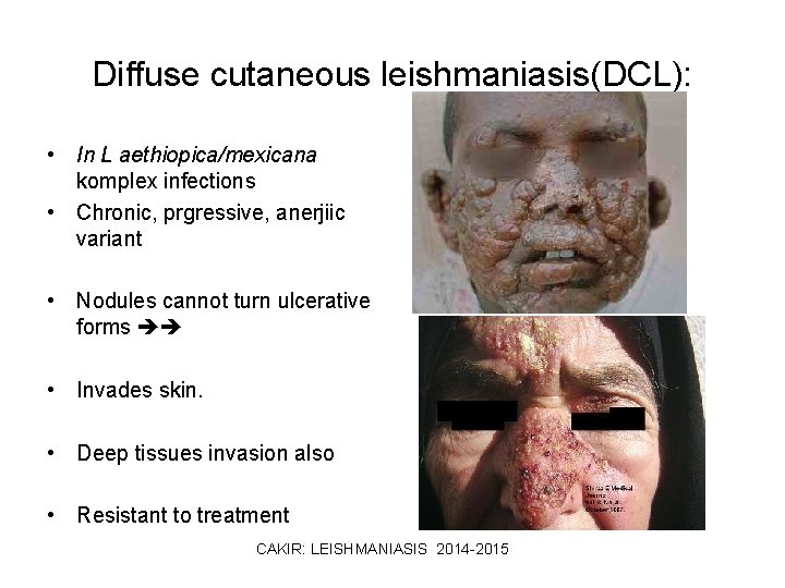 Diffuse cutaneous leishmaniasis(DCL): • In L aethiopica/mexicana komplex infections • Chronic, prgressive, anerjiic variant