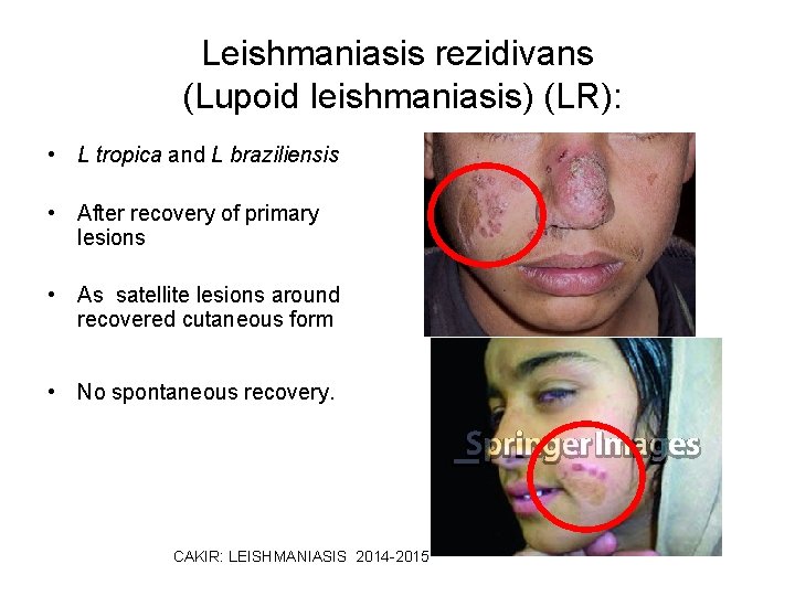 Leishmaniasis rezidivans (Lupoid leishmaniasis) (LR): • L tropica and L braziliensis • After recovery