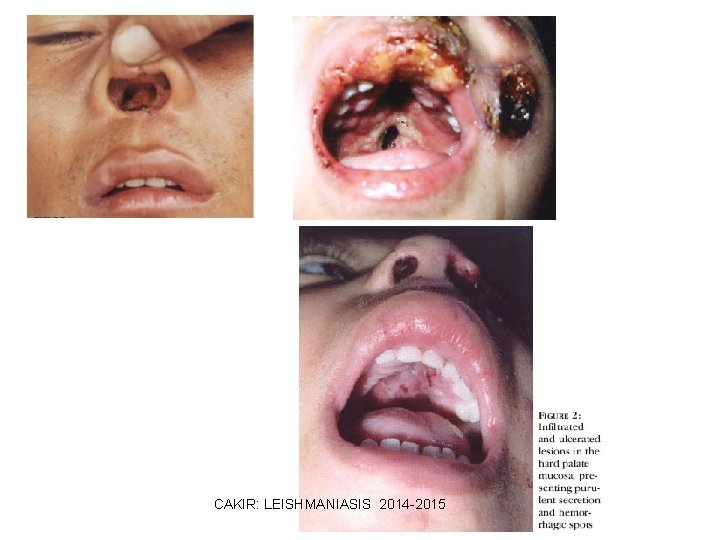 CAKIR: LEISHMANIASIS 2014 -2015 