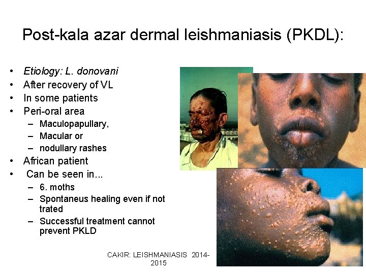 Post-kala azar dermal leishmaniasis (PKDL): • • Etiology: L. donovani After recovery of VL