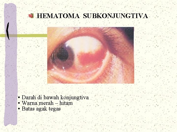 HEMATOMA SUBKONJUNGTIVA • Darah di bawah konjungtiva • Warna merah – hitam • Batas HEMATOMA SUBKONJUNGTIVA • Darah di bawah konjungtiva • Warna merah – hitam • Batas