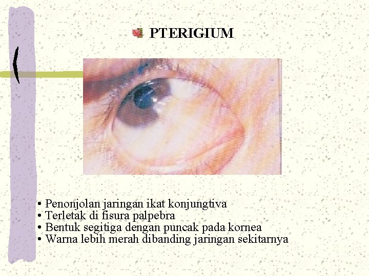 PTERIGIUM • Penonjolan jaringan ikat konjungtiva • Terletak di fisura palpebra • Bentuk segitiga PTERIGIUM • Penonjolan jaringan ikat konjungtiva • Terletak di fisura palpebra • Bentuk segitiga