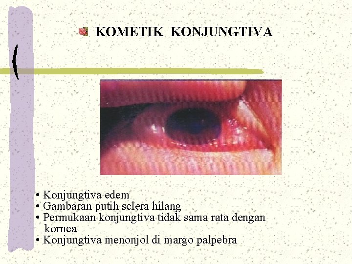 KOMETIK KONJUNGTIVA • Konjungtiva edem • Gambaran putih sclera hilang • Permukaan konjungtiva tidak KOMETIK KONJUNGTIVA • Konjungtiva edem • Gambaran putih sclera hilang • Permukaan konjungtiva tidak
