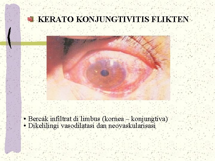 KERATO KONJUNGTIVITIS FLIKTEN • Bercak infiltrat di limbus (kornea – konjungtiva) • Dikelilingi vasodilatasi KERATO KONJUNGTIVITIS FLIKTEN • Bercak infiltrat di limbus (kornea – konjungtiva) • Dikelilingi vasodilatasi
