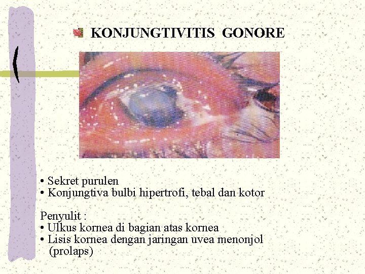 KONJUNGTIVITIS GONORE • Sekret purulen • Konjungtiva bulbi hipertrofi, tebal dan kotor Penyulit : KONJUNGTIVITIS GONORE • Sekret purulen • Konjungtiva bulbi hipertrofi, tebal dan kotor Penyulit :