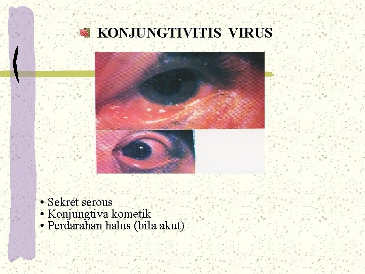 KONJUNGTIVITIS VIRUS • Sekret serous • Konjungtiva kometik • Perdarahan halus (bila akut) KONJUNGTIVITIS VIRUS • Sekret serous • Konjungtiva kometik • Perdarahan halus (bila akut)