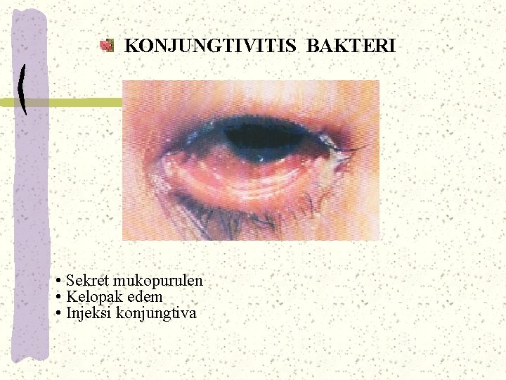 KONJUNGTIVITIS BAKTERI • Sekret mukopurulen • Kelopak edem • Injeksi konjungtiva KONJUNGTIVITIS BAKTERI • Sekret mukopurulen • Kelopak edem • Injeksi konjungtiva