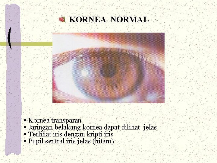 KORNEA NORMAL • Kornea transparan • Jaringan belakang kornea dapat dilihat jelas • Terlihat KORNEA NORMAL • Kornea transparan • Jaringan belakang kornea dapat dilihat jelas • Terlihat