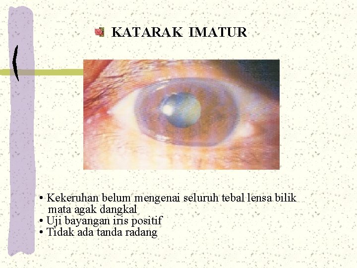 KATARAK IMATUR • Kekeruhan belum mengenai seluruh tebal lensa bilik mata agak dangkal • KATARAK IMATUR • Kekeruhan belum mengenai seluruh tebal lensa bilik mata agak dangkal •
