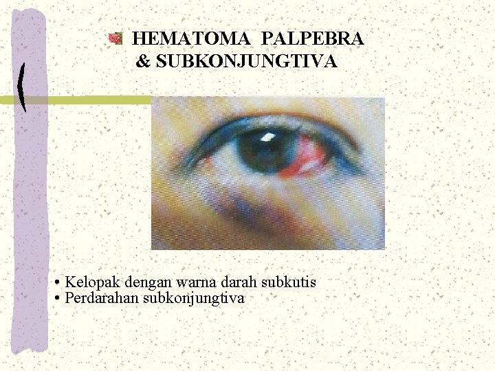 HEMATOMA PALPEBRA & SUBKONJUNGTIVA • Kelopak dengan warna darah subkutis • Perdarahan subkonjungtiva HEMATOMA PALPEBRA & SUBKONJUNGTIVA • Kelopak dengan warna darah subkutis • Perdarahan subkonjungtiva