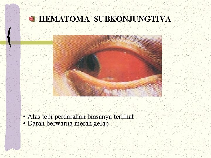 HEMATOMA SUBKONJUNGTIVA • Atas tepi perdarahan biasanya terlihat • Darah berwarna merah gelap HEMATOMA SUBKONJUNGTIVA • Atas tepi perdarahan biasanya terlihat • Darah berwarna merah gelap