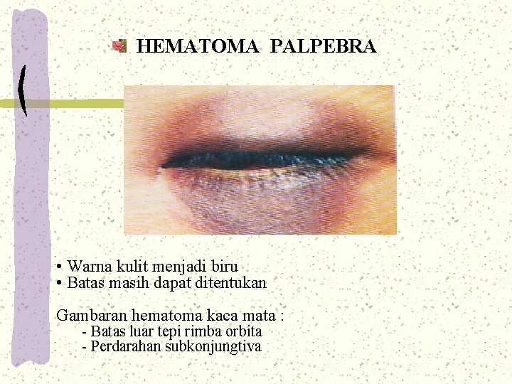 HEMATOMA PALPEBRA • Warna kulit menjadi biru • Batas masih dapat ditentukan Gambaran hematoma HEMATOMA PALPEBRA • Warna kulit menjadi biru • Batas masih dapat ditentukan Gambaran hematoma