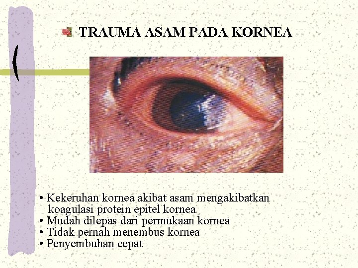 TRAUMA ASAM PADA KORNEA • Kekeruhan kornea akibat asam mengakibatkan koagulasi protein epitel kornea TRAUMA ASAM PADA KORNEA • Kekeruhan kornea akibat asam mengakibatkan koagulasi protein epitel kornea