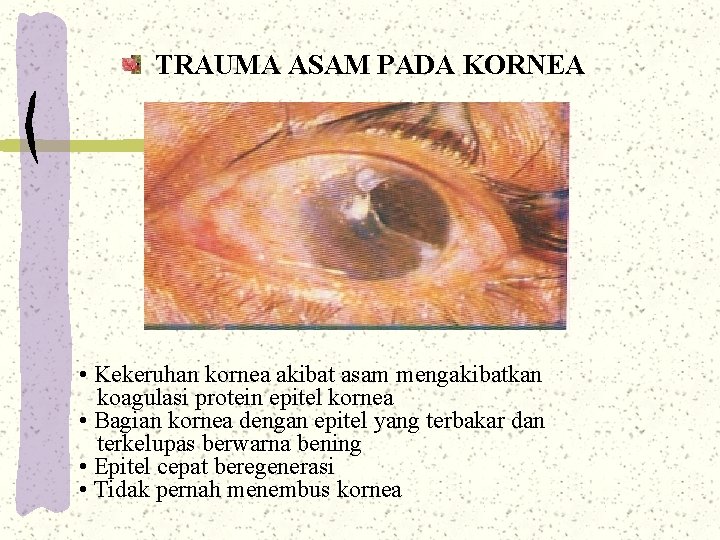 TRAUMA ASAM PADA KORNEA • Kekeruhan kornea akibat asam mengakibatkan koagulasi protein epitel kornea TRAUMA ASAM PADA KORNEA • Kekeruhan kornea akibat asam mengakibatkan koagulasi protein epitel kornea
