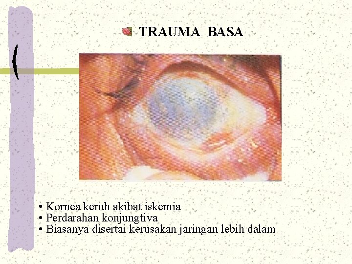 TRAUMA BASA • Kornea keruh akibat iskemia • Perdarahan konjungtiva • Biasanya disertai kerusakan TRAUMA BASA • Kornea keruh akibat iskemia • Perdarahan konjungtiva • Biasanya disertai kerusakan
