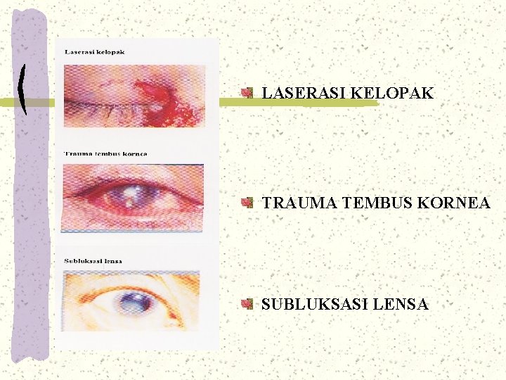 LASERASI KELOPAK TRAUMA TEMBUS KORNEA SUBLUKSASI LENSA LASERASI KELOPAK TRAUMA TEMBUS KORNEA SUBLUKSASI LENSA