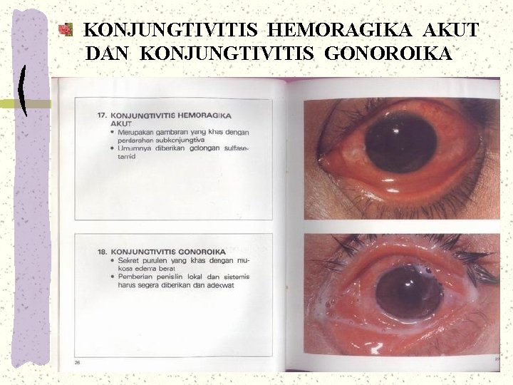 KONJUNGTIVITIS HEMORAGIKA AKUT DAN KONJUNGTIVITIS GONOROIKA KONJUNGTIVITIS HEMORAGIKA AKUT DAN KONJUNGTIVITIS GONOROIKA