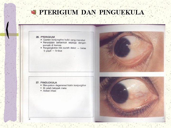 PTERIGIUM DAN PINGUEKULA PTERIGIUM DAN PINGUEKULA