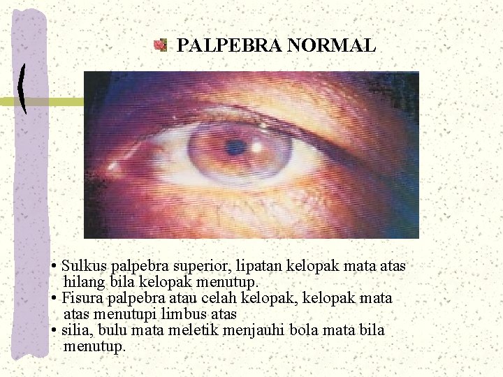 PALPEBRA NORMAL • Sulkus palpebra superior, lipatan kelopak mata atas hilang bila kelopak menutup. PALPEBRA NORMAL • Sulkus palpebra superior, lipatan kelopak mata atas hilang bila kelopak menutup.